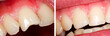 Fractured tooth (incisor) - part of Beforeafter series.