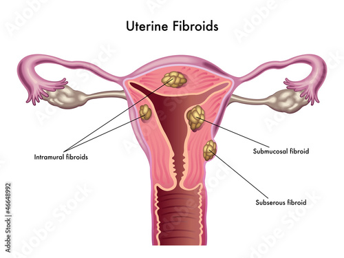 Vettoriale: fibroma uterino fibroma uterino