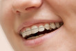 the young girl smiling with braces on teeth