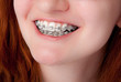 dental care concept. Teeth with braces