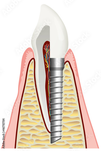 Illustration: Zahnimplantat / Implantologie Zahnimplantat / Implantologie