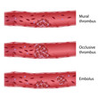Types of thrombosis, eps10