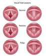 Vocal cord lesions, eps8