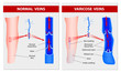 VARICOSE VEINS. Medical illustration