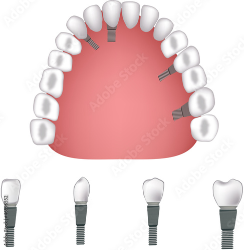 Vector: proteasi dentale -dental prosthesis proteasi dentale -dental prosthesis