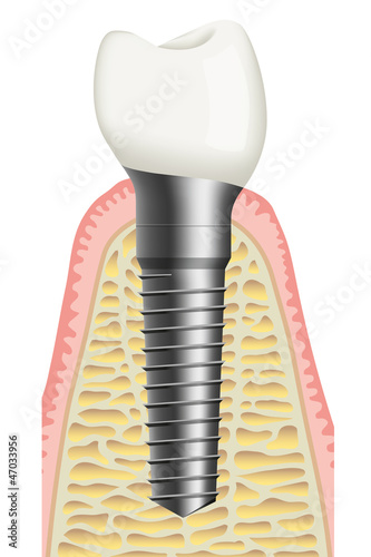 Illustration: Zahnimplantat / Implantologie Zahnimplantat / Implantologie