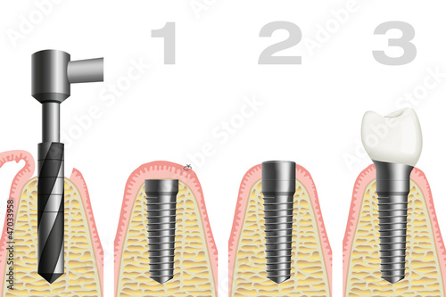 Illustration: Zahnimplantat / Implantologie Zahnimplantat / Implantologie