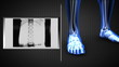 Montage on x-rays
