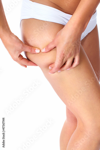 Photo: Woman having a cellulite. Woman having a cellulite.