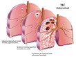 tubercolosi