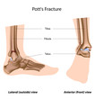 Pott's fracture, eps8