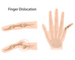 Finger dislocation, eps10