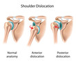 Dislocated shoulder, eps8
