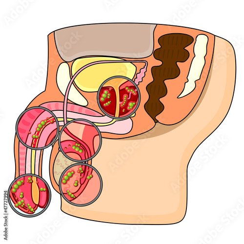 Vector: Diseases of male reproductive system Diseases of male reproductive system