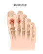 Broken toe, eps10