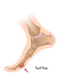 Turf toe, eps10