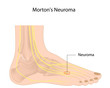 Morton’s neuroma, eps10