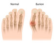 Bunion in foot, eps10