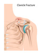 Clavicle fracture, eps10