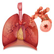 Asthma