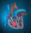 Heart attack