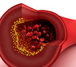 Illustration: Closeup view of cholesterol plaque in blood vessel Closeup view of cholesterol plaque in blood vessel