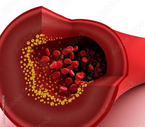 Illustration: Closeup view of cholesterol plaque in blood vessel Closeup view of cholesterol plaque in blood vessel