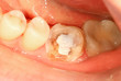 Teeth restoration