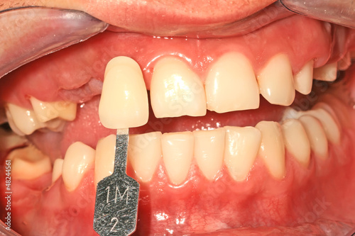 Photo: Color choice of teeth Color choice of teeth