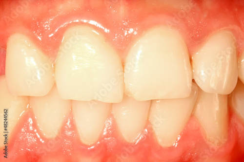 Photo: Frontal teeth Frontal teeth