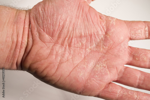 Photo: Ekzem Hand Ekzem Hand
