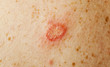 microsporia a fungus