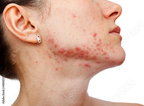 Photo: Young girl with skin problem Young girl with skin problem