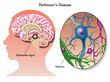 Morbo di Parkinson