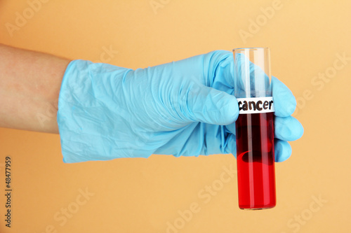 Photo: Test tube labeled Cancer in hand on beige background Test tube labeled Cancer in hand on beige background