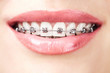 Photo: teeth with braces teeth with braces