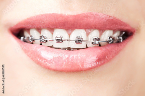 Photo: teeth with braces teeth with braces