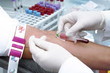 A doctor is taking blood for test.