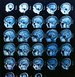 IRM du cerveau