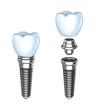 Tooth implant. Аssembled and disassembled. Isolated on white.