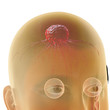 Hirntumor - 3D Render