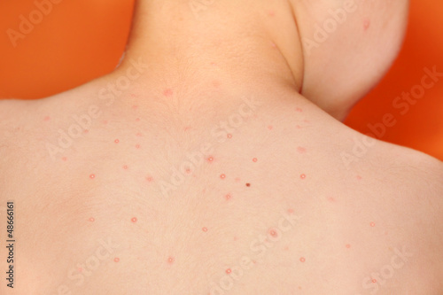 Photo: Baby boy with chicken pox rash Baby boy with chicken pox rash
