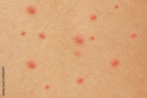 Photo: Detail baby with chicken pox rash Detail baby with chicken pox rash