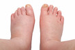 two swollen legs