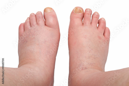 Photo: two swollen legs two swollen legs