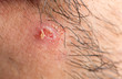 Exploded pimple