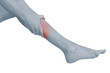 Acute pain in a woman calf