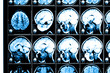 X-ray image of the brain computed tomography