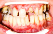 Unhealhty teeth
