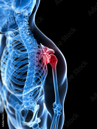 Illustration: 3d rendered illustration of a painful shoulder 3d rendered illustration of a painful shoulder